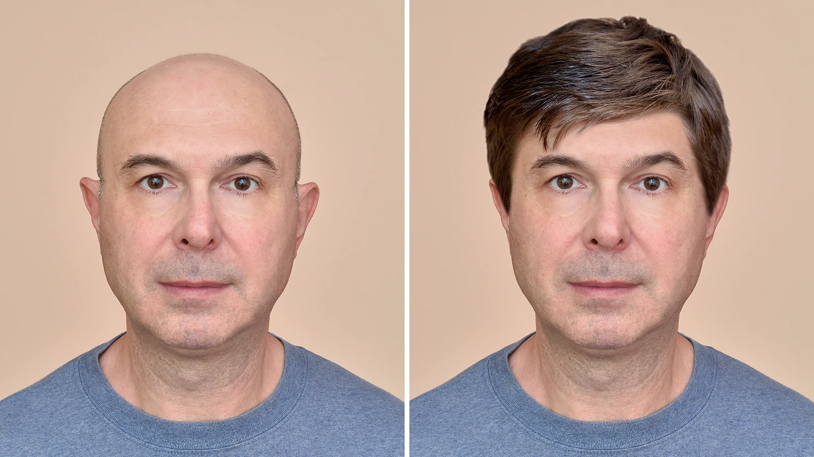 Toupee and alternatives without surgery